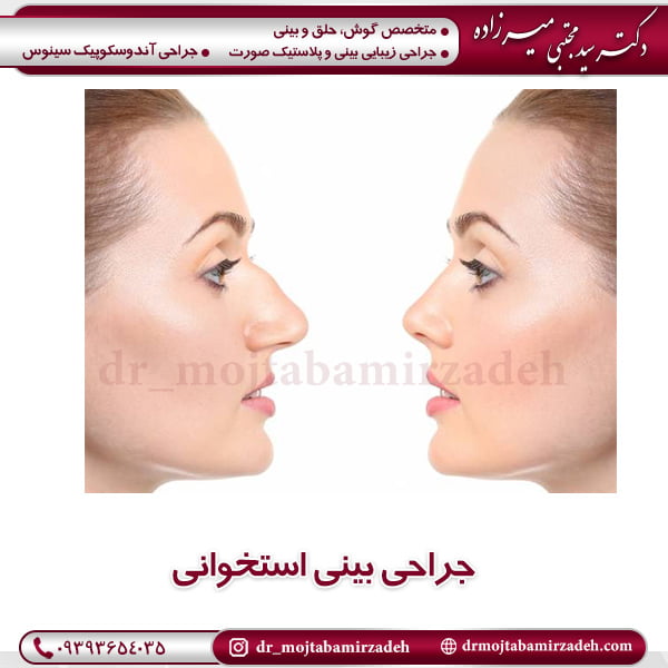جراحی بینی استخوانی - دکتر مجتبی میرزاده