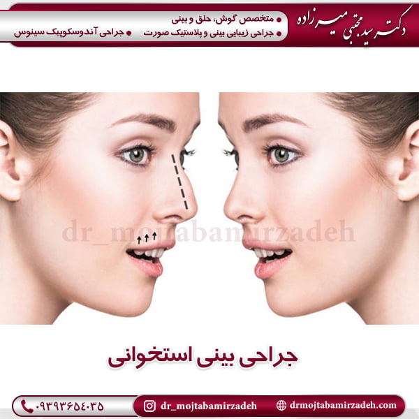 جراحی بینی استخوانی - دکتر سید مجتبی میرزاده