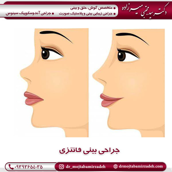 تاثیر عمل عروسکی - دکتر مجتبی میرزاده