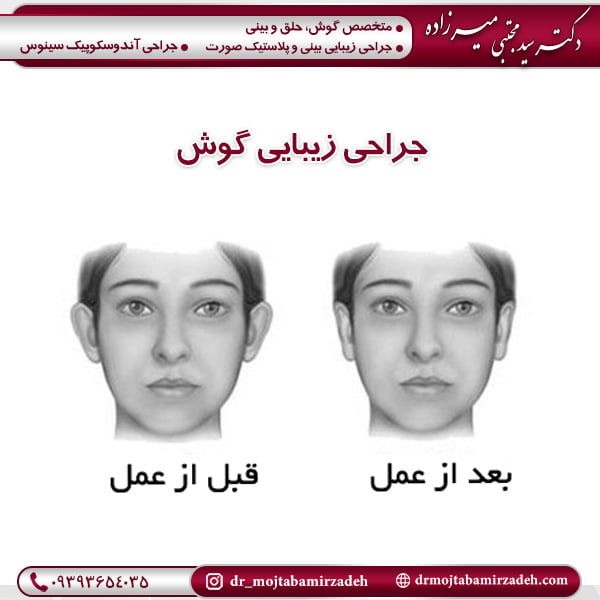 جراحی زیبایی گوش