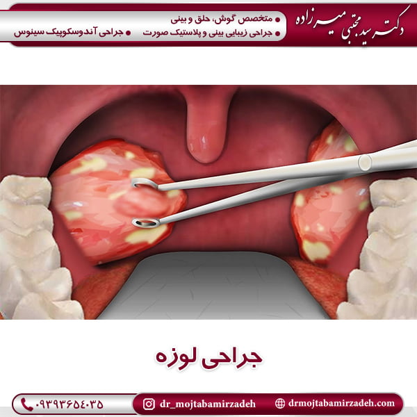 جراحی لوزه