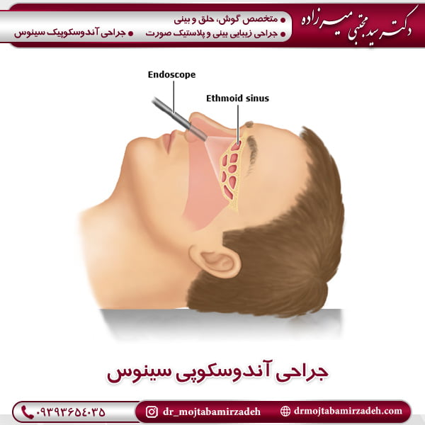 جراحی آندوسکوپی سینوس