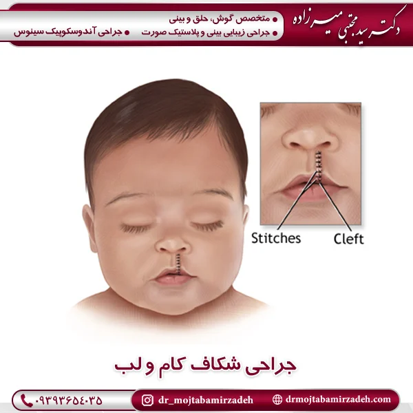 جراحی شکاف کام و لب