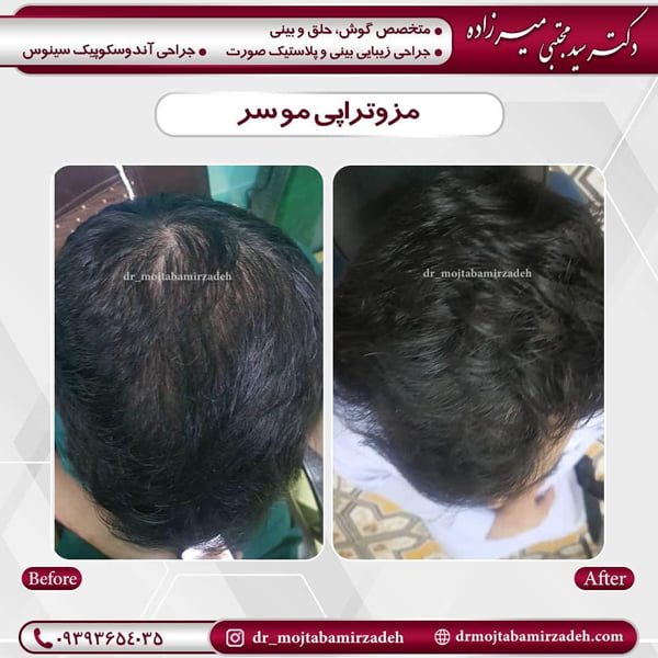 مزوتراپی