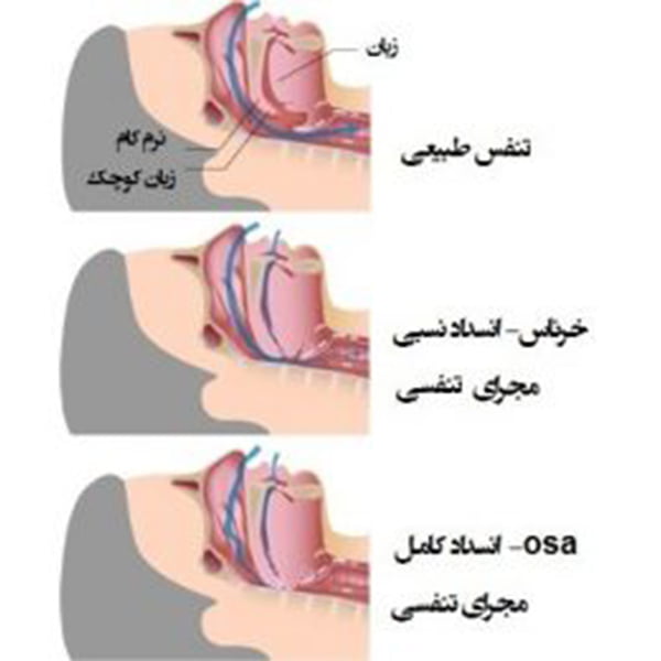آپنه خواب - دکتر میرزاده