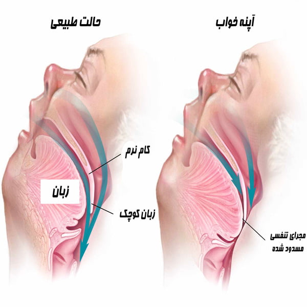 آپنه خواب - دکتر میرزاده