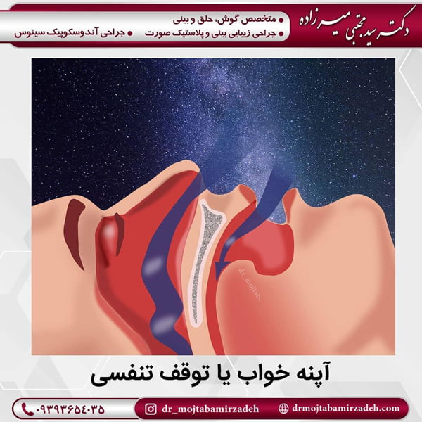 آپنه خواب - دکتر میرزاده 