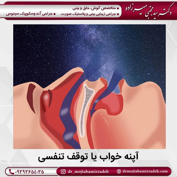آپنه خواب