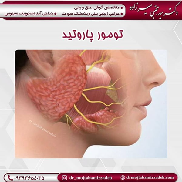تومور پاروتید