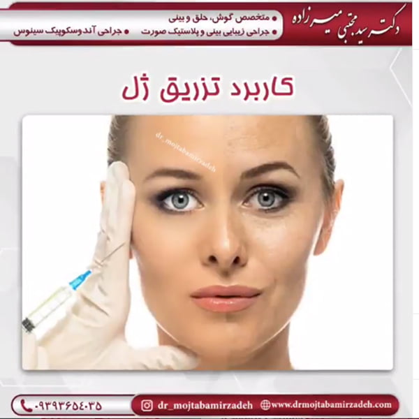 تزریق ژل