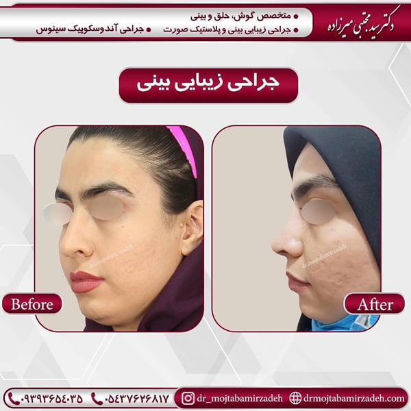 جراحی بینی گوشتی در تهران - دکتر سید مجتبی میرزاده