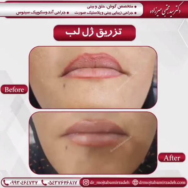 تزریق ژل لب
