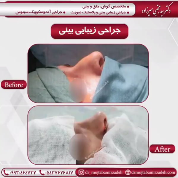 قبل و بعد از عمل - دکتر میرزاده