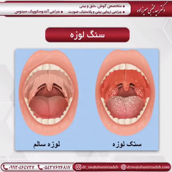 سنگ لوزه