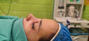 بلافاصله پس از رینوپلاستی بین یاستخوانی _ دکتر مجتبی میرزاده
