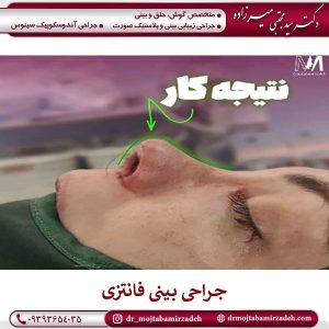جراحی بینی فانتزی در یزد _ دکتر مجتبی میرزاده