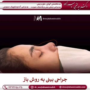 جراحی بینی به روش باز در یزد _ دکتر مجتبی میرزاده 