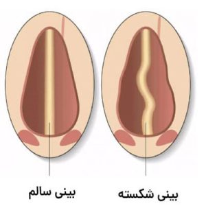 عمل بیین شکسته در یزد _ دکتر مجتبی میرزاده