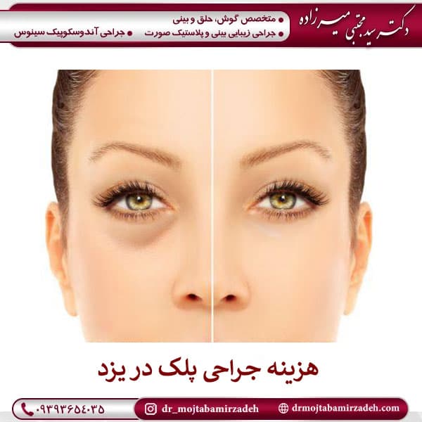 هزینه جراحی پلک ( جراحی بلفاروپلاستی) در یزد