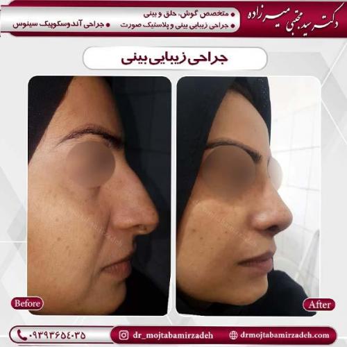 جراحی-بینی-13