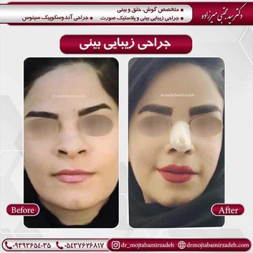 جراحی-بینی-15