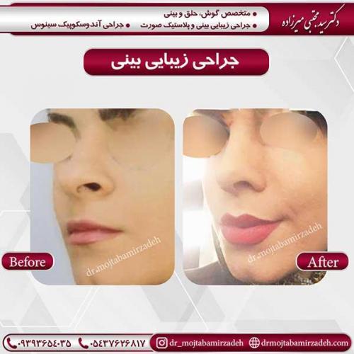 جراحی-بینی-17