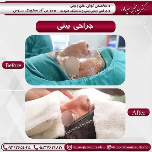 جراحی-بینی-21