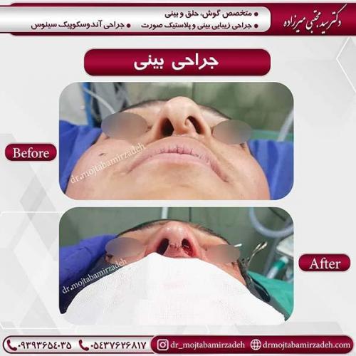جراحی-بینی-22