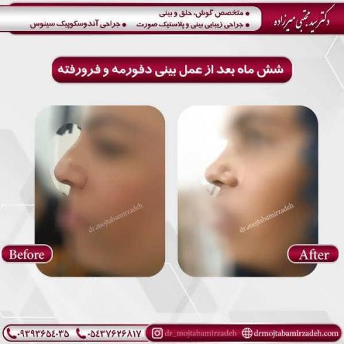 جراحی-بینی-26
