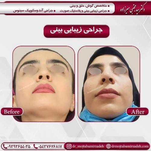 جراحی-بینی-34