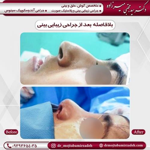 جراحی-بینی-4