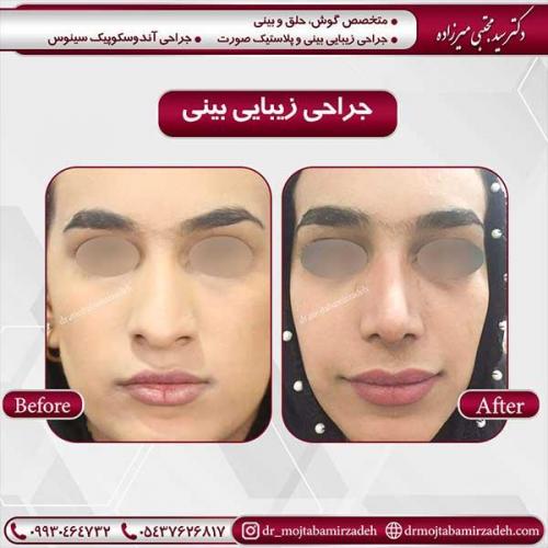جراحی-بینی-41