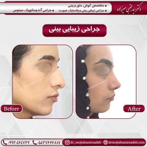 جراحی-بینی-42