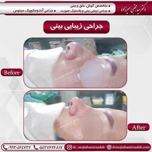 جراحی-بینی-43