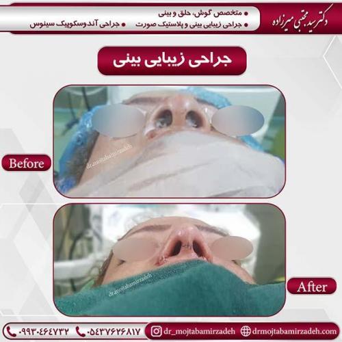 جراحی-بینی-44