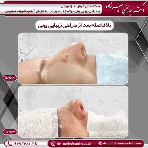 جراحی-بینی-5