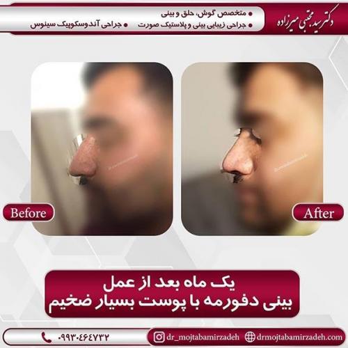 جراحی-بینی-50