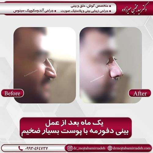 جراحی-بینی-51