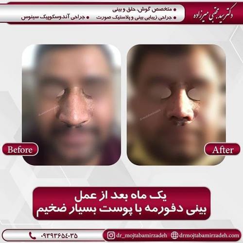 جراحی-بینی-52