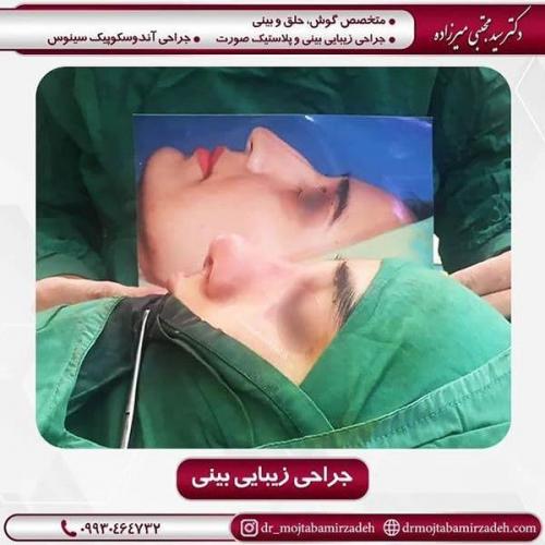 جراحی-بینی-53
