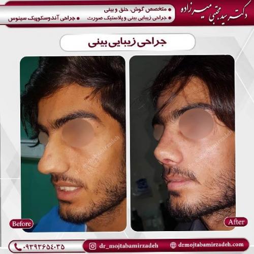 جراحی-بینی-6