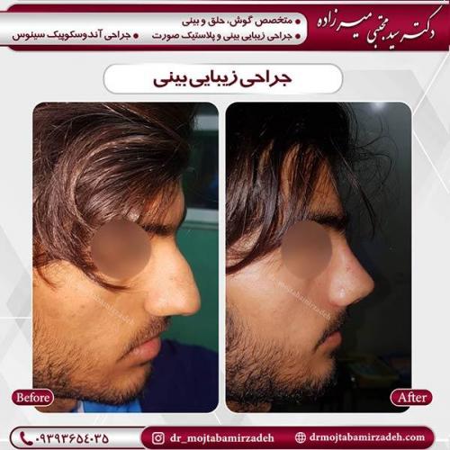 جراحی-بینی-7