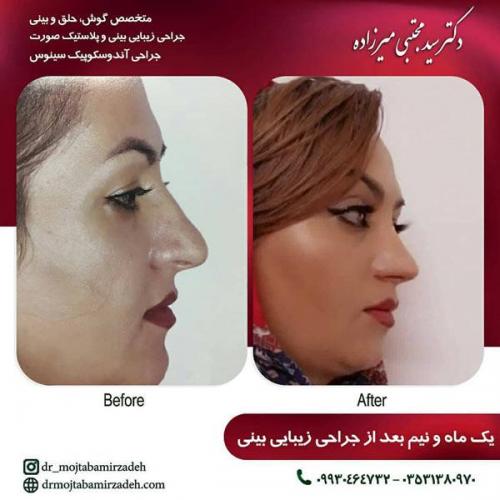 جراحی-بینی-یزد-90