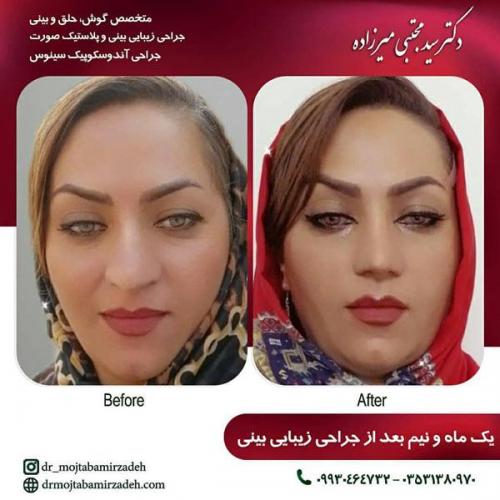جراحی-بینی-یزد-91