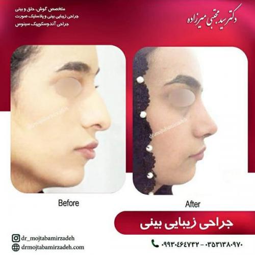 جراحی-بینی-یزد101