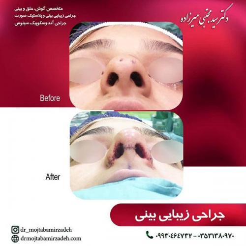 جراحی-بینی-یزد102
