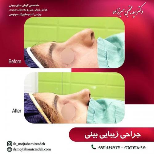 جراحی-بینی-یزد103
