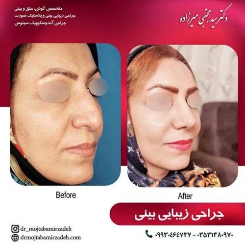 جراحی-بینی-یزد105