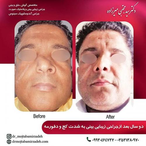 جراحی-بینی-یزد108