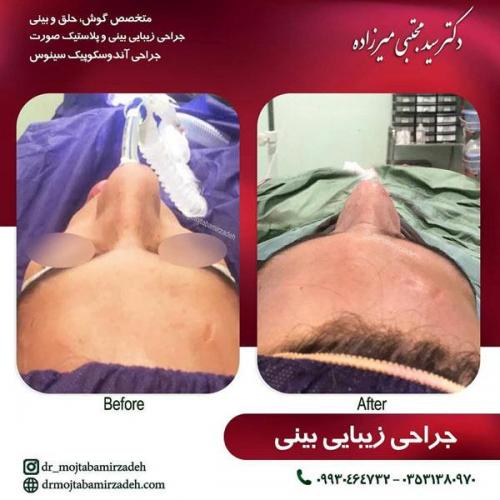 جراحی-بینی-یزد111